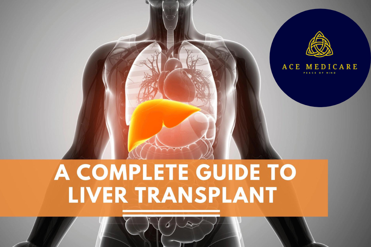 The Ultimate Guide to Liver Transplant: Everything You Need to Know